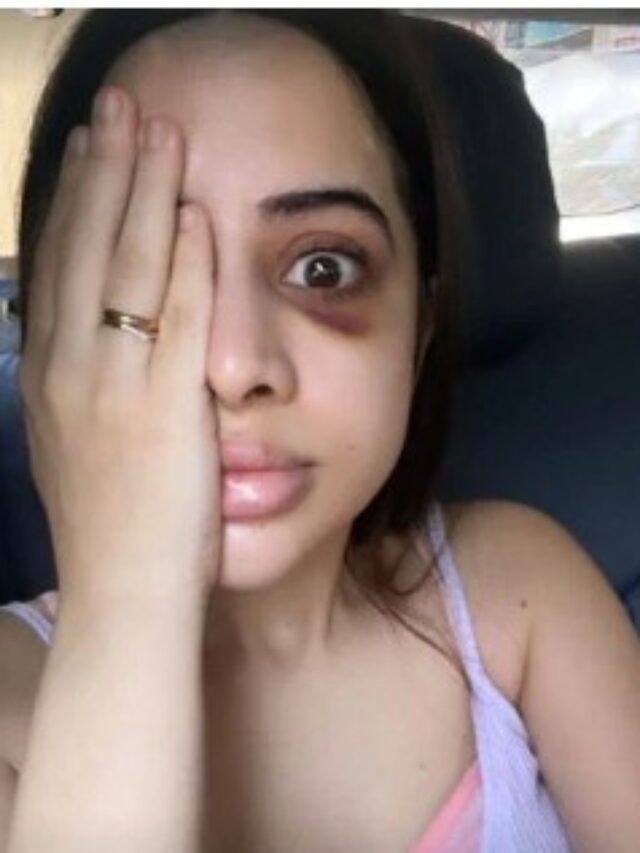 उर्फी जावेद के चेहरे को क्या हो गया! शेयर की तस्वीर