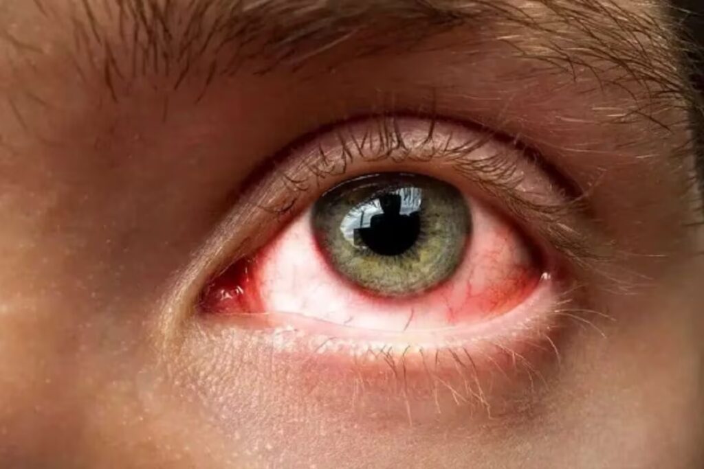 Eye flu treatment